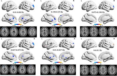 Amplitude of Low-Frequency Fluctuation in Multiple Frequency Bands in Tension-Type Headache Patients: A Resting-State Functional Magnetic Resonance Imaging Study